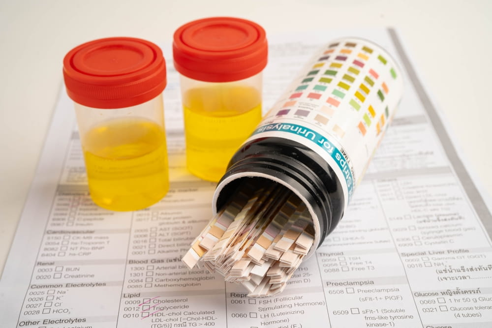 انواع آزمایش ادرار و تاثیر تغذیه بر آن‌ها