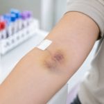 علت کبود شدن دست بعد از خون دادن یا سرم زدن چیست؟