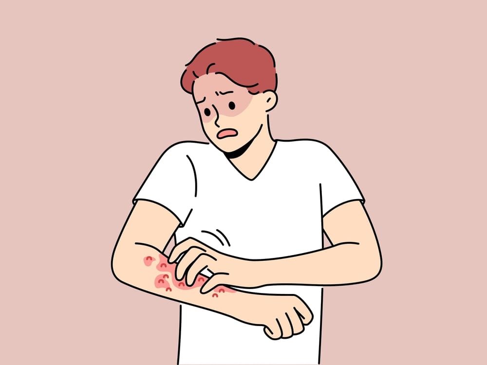 پیشگیری از کهیر عصبی