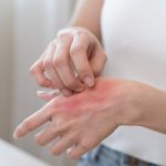 کهیر عصبی چیست؟ | درمان کهیر عصبی در خانه
